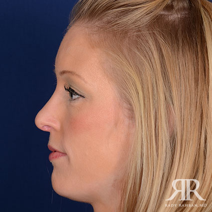 Female Rhinoplasty