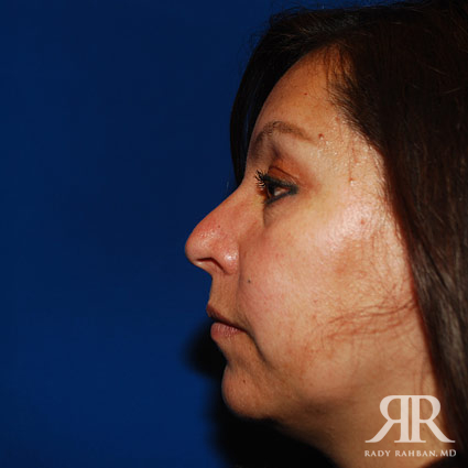 Female Rhinoplasty