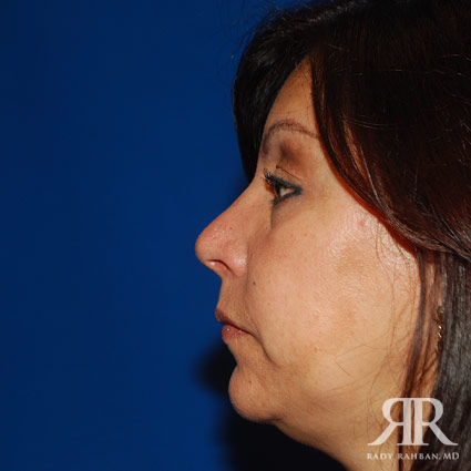 Female Rhinoplasty