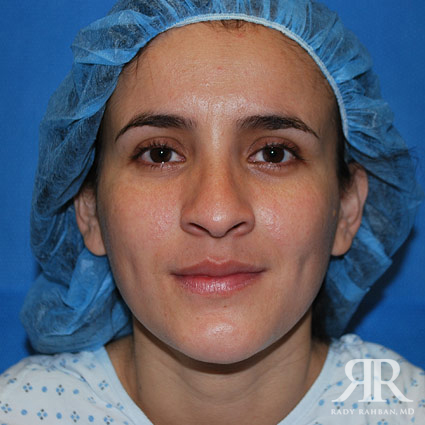 Female Rhinoplasty