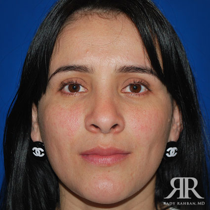 Female Rhinoplasty