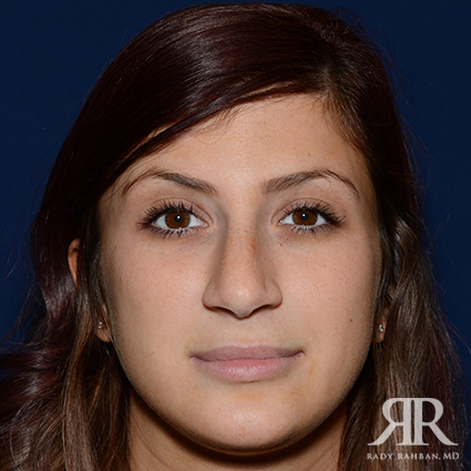 Female Rhinoplasty