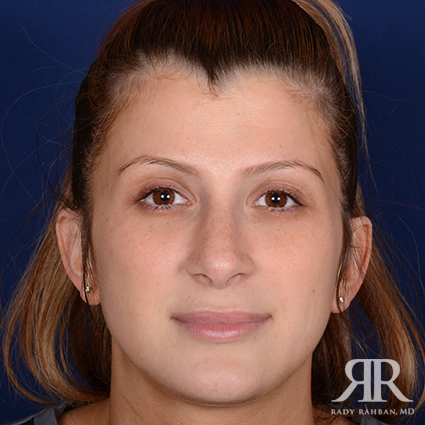 Female Rhinoplasty