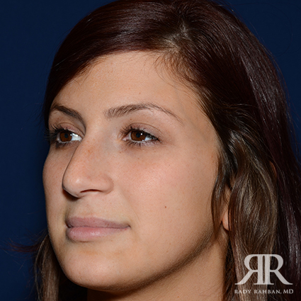 Female Rhinoplasty