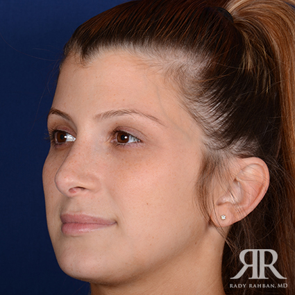 Female Rhinoplasty