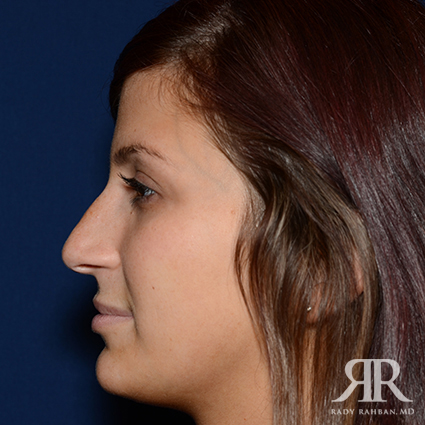 Female Rhinoplasty