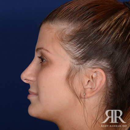 Female Rhinoplasty