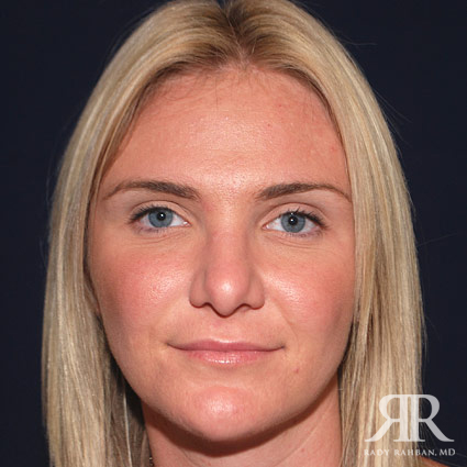 Female Rhinoplasty