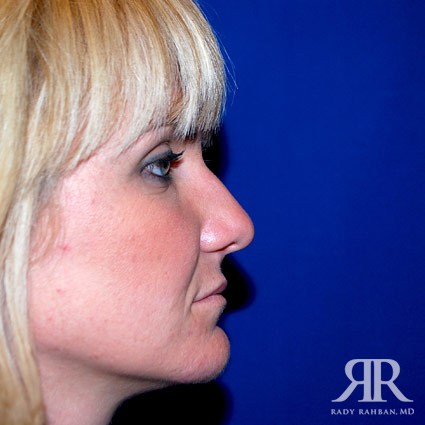 Female Rhinoplasty