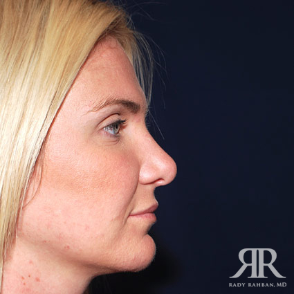 Female Rhinoplasty