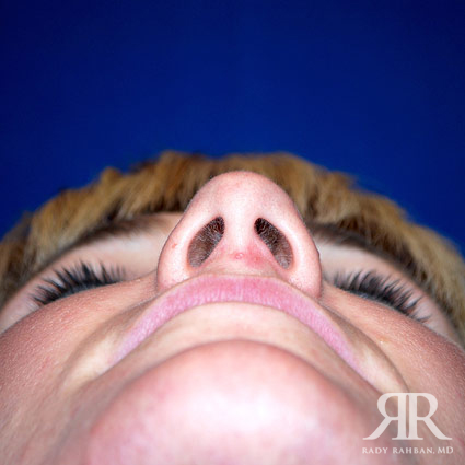 Female Rhinoplasty