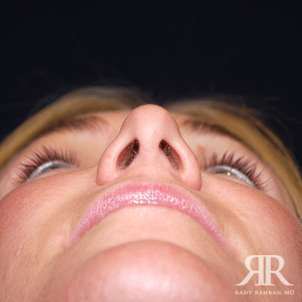 Female Rhinoplasty