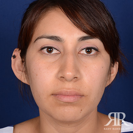 Female Rhinoplasty