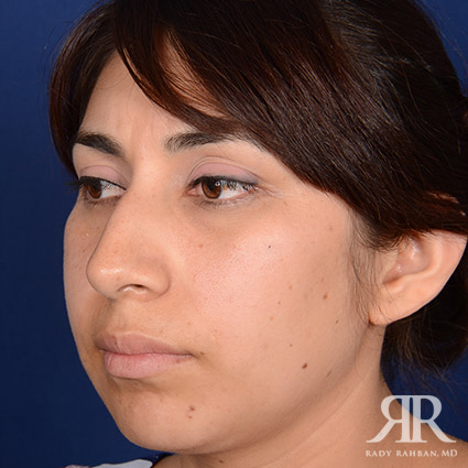 Female Rhinoplasty