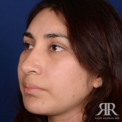 Female Rhinoplasty