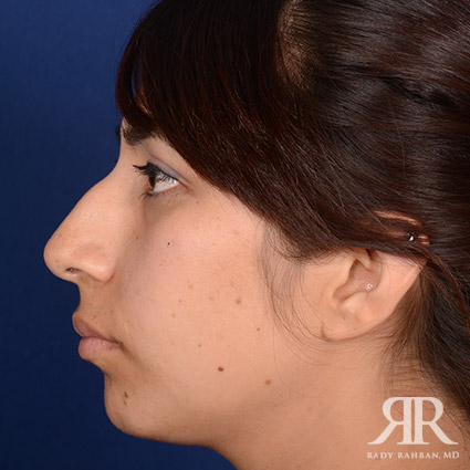 Female Rhinoplasty