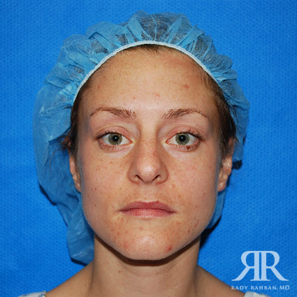 Female Rhinoplasty