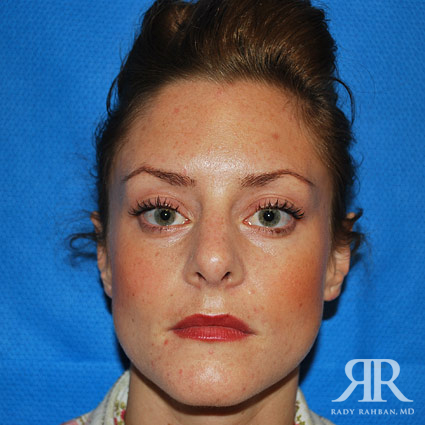 Female Rhinoplasty
