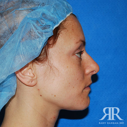 Female Rhinoplasty