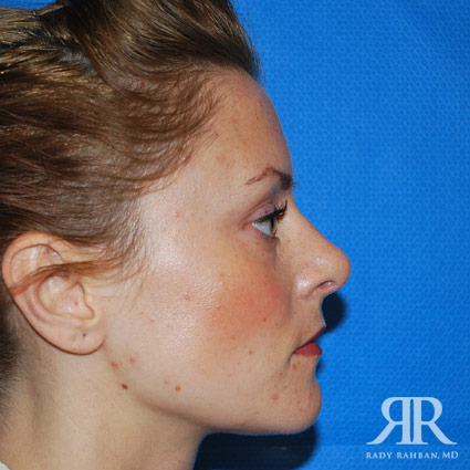 Female Rhinoplasty