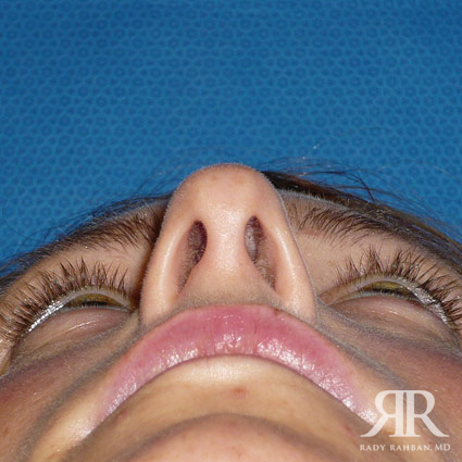 Female Rhinoplasty