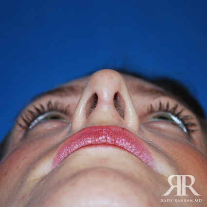 Female Rhinoplasty