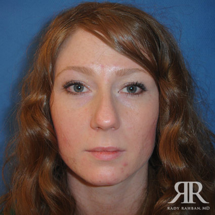 Female Rhinoplasty