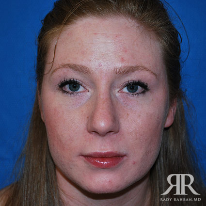 Female Rhinoplasty