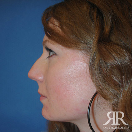 Female Rhinoplasty