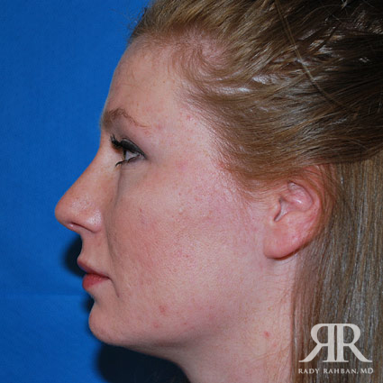 Female Rhinoplasty