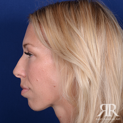 Female Rhinoplasty