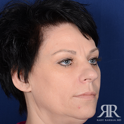 Female Rhinoplasty