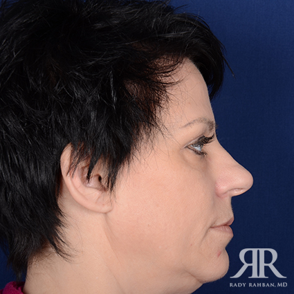 Female Rhinoplasty