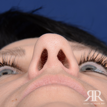 Female Rhinoplasty