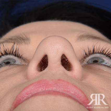 Female Rhinoplasty