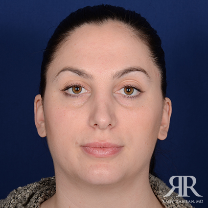 Female Rhinoplasty