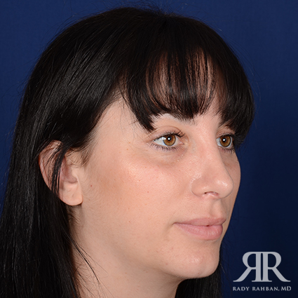 Female Rhinoplasty