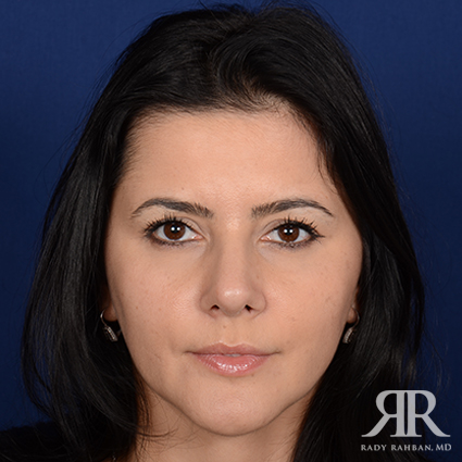 Female Rhinoplasty