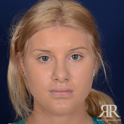 Female Rhinoplasty