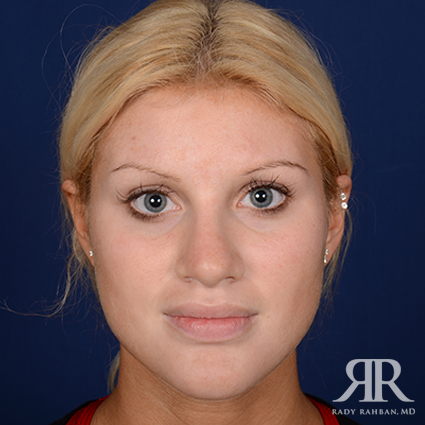 Female Rhinoplasty