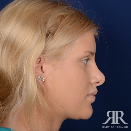 Female Rhinoplasty