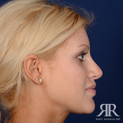 Female Rhinoplasty