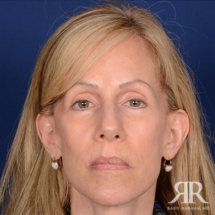 Female Rhinoplasty