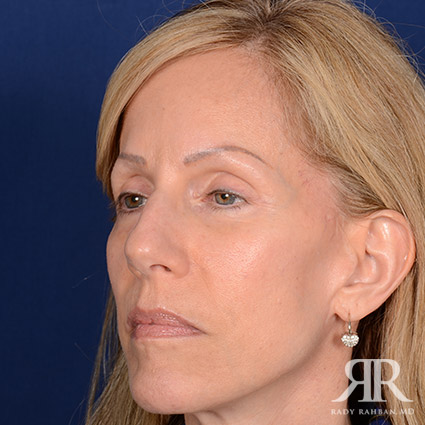 Female Rhinoplasty