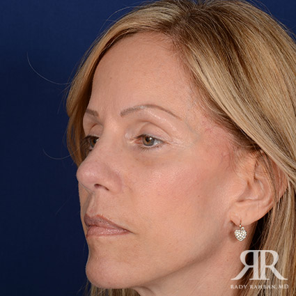 Female Rhinoplasty