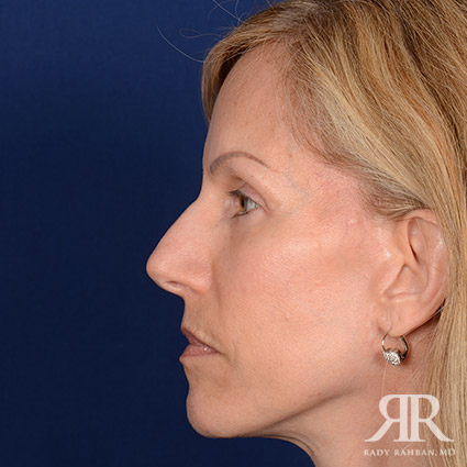 Female Rhinoplasty