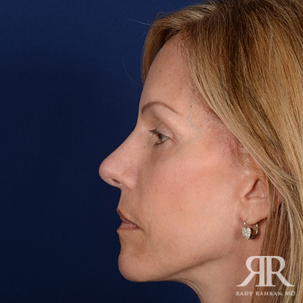 Female Rhinoplasty