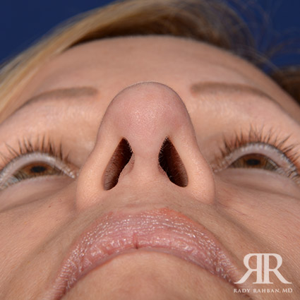 Female Rhinoplasty