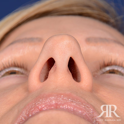 Female Rhinoplasty