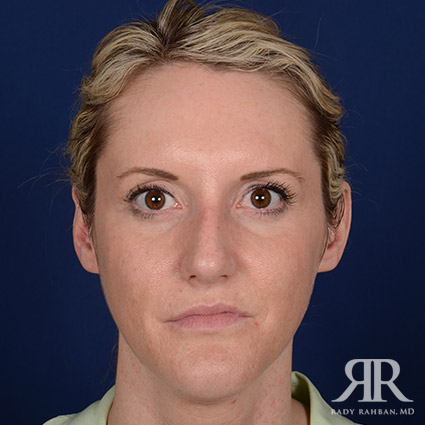 Female Rhinoplasty